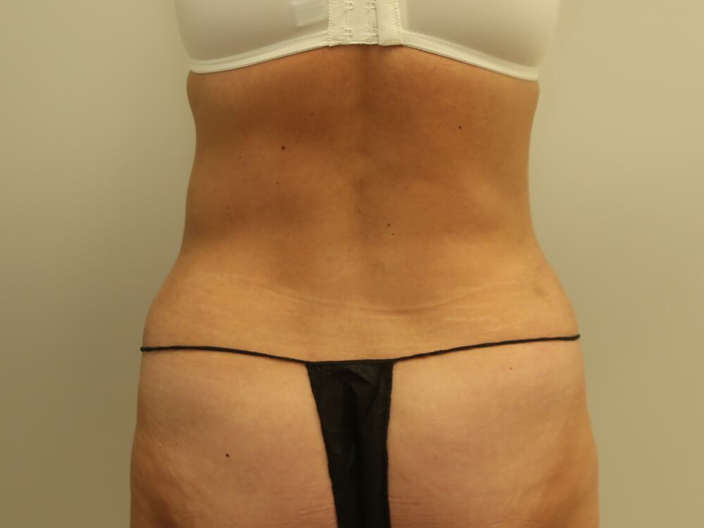Tummy Tuck Before & After Image