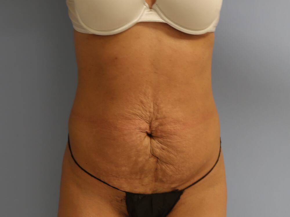 Tummy tuck Before & After Image
