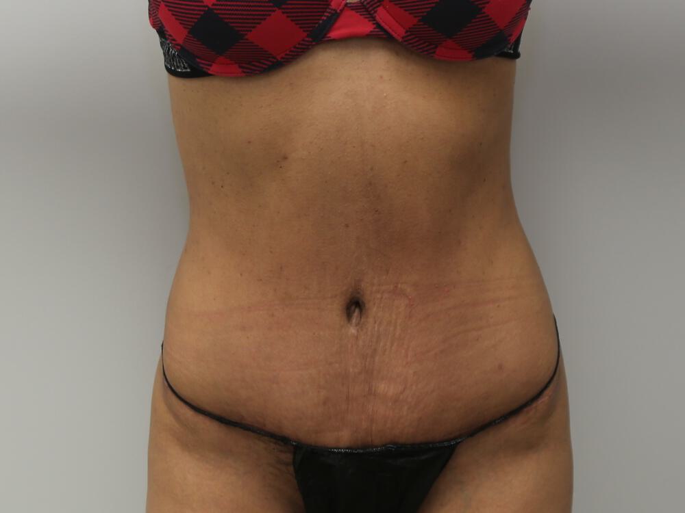 Tummy tuck Before & After Image