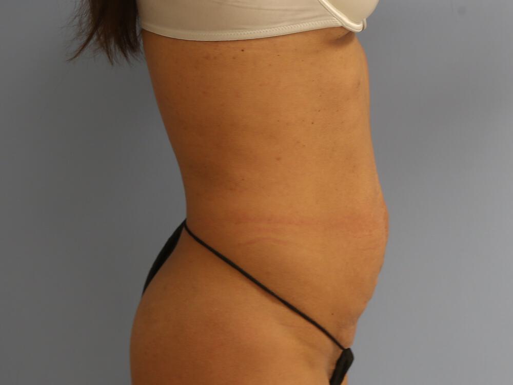 Tummy tuck Before & After Image