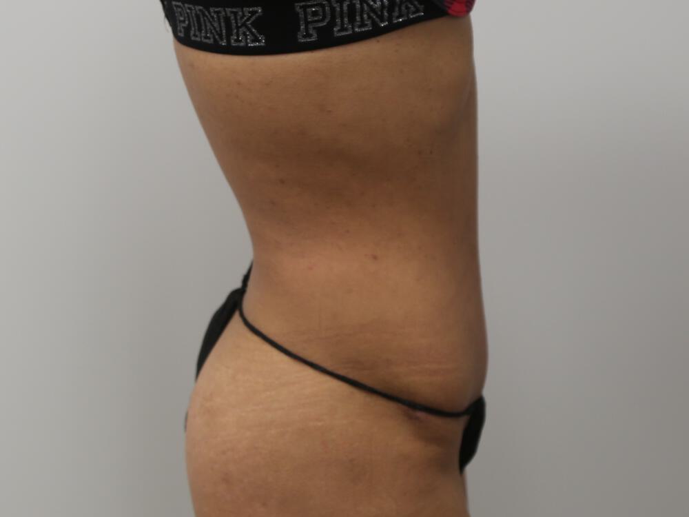 Tummy tuck Before & After Image