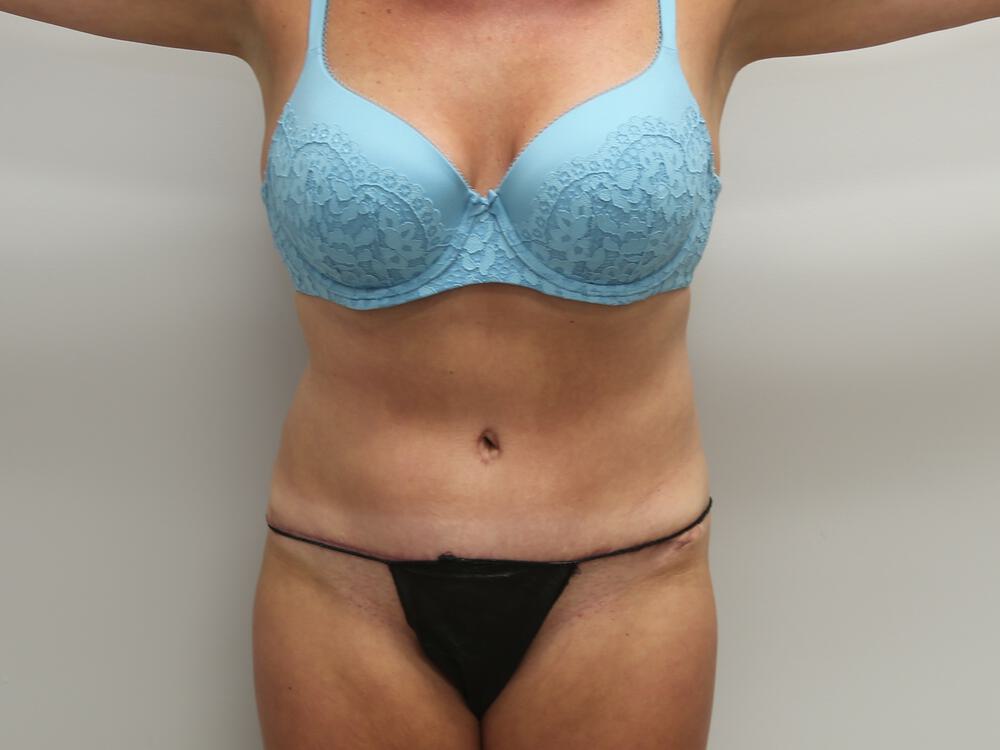 Tummy tuck Before & After Image