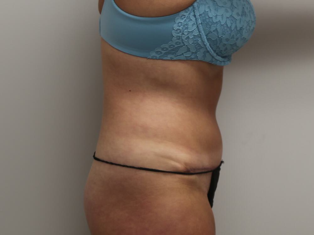 Tummy tuck Before & After Image