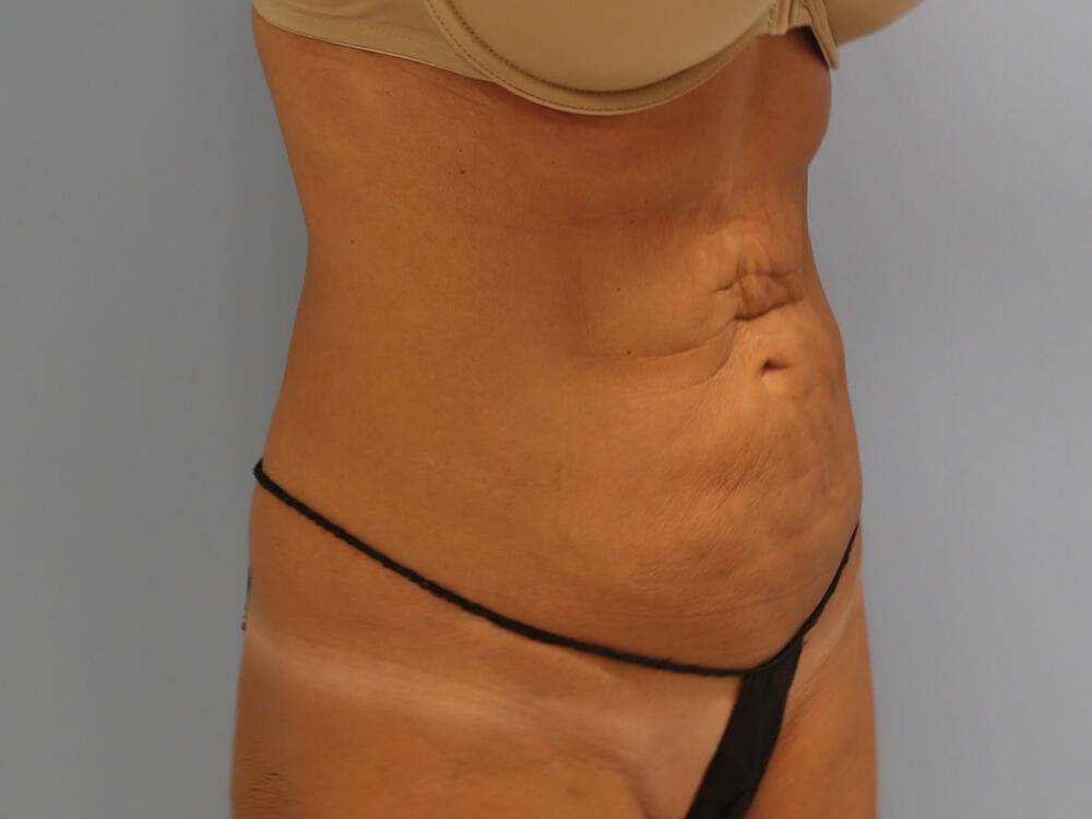 Tummy tuck Before & After Image
