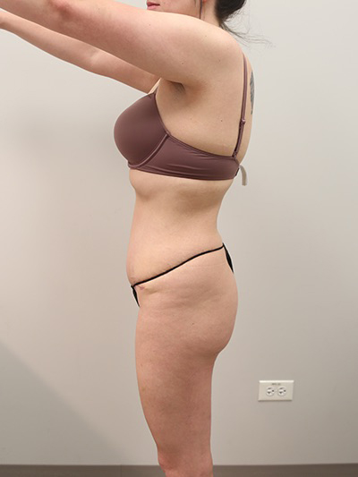 Tummy tuck Before & After Image