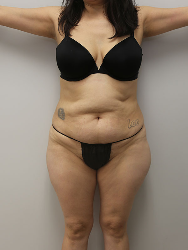 Tummy tuck Before & After Image