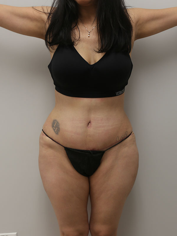 Tummy tuck Before & After Image