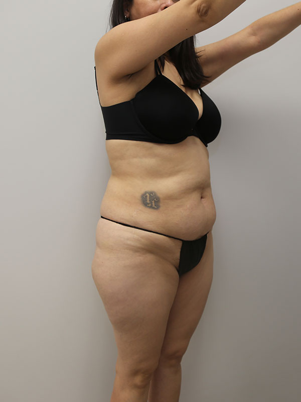 Tummy Tuck Before & After Image