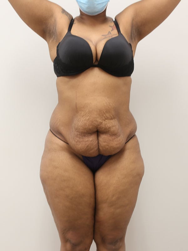 Tummy tuck Before & After Image