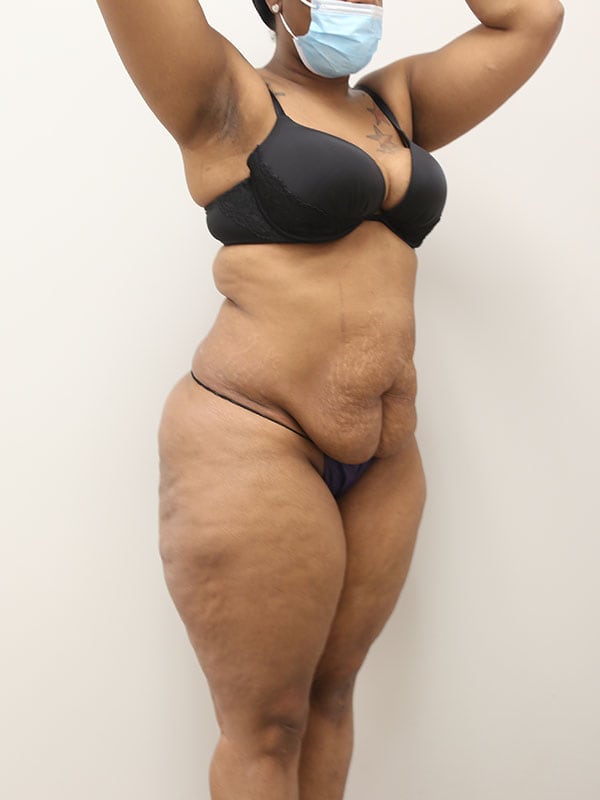 Tummy Tuck Before & After Image