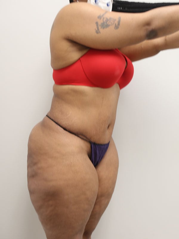 Tummy Tuck Before & After Image