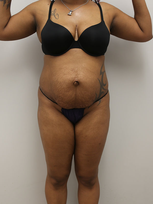 Tummy tuck Before & After Image