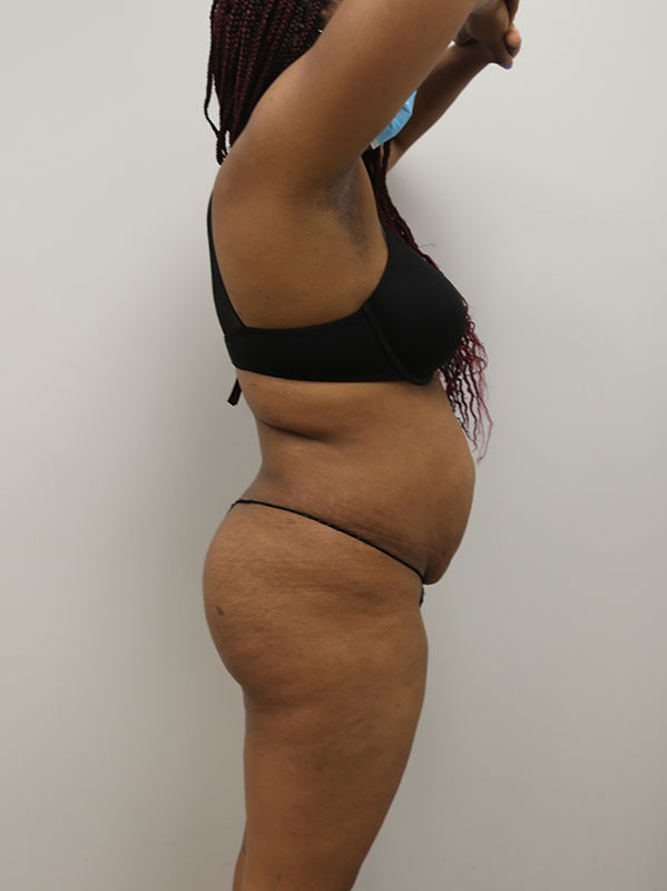 Tummy tuck Before & After Image