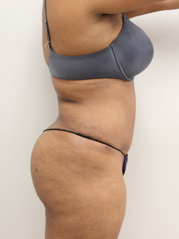 Tummy tuck Before & After Image