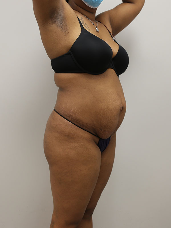 Tummy Tuck Before & After Image