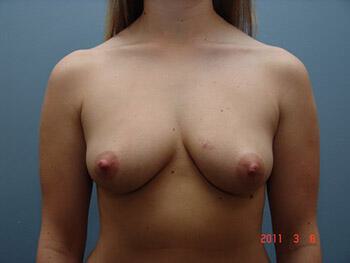 Breast Augmentation Before & After Image