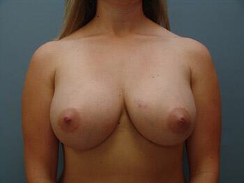 Breast Augmentation Before & After Image