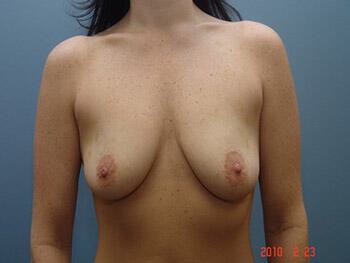Breast Augmentation Before & After Image