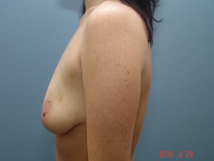 Breast Augmentation Before & After Image