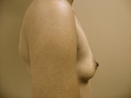 Breast augmentation Before & After Image