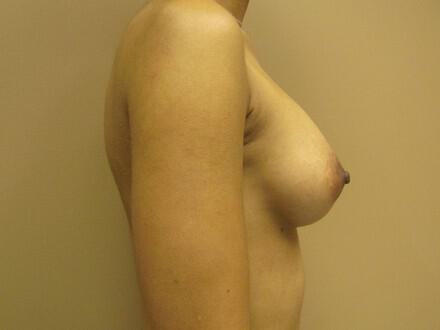 Breast augmentation Before & After Image