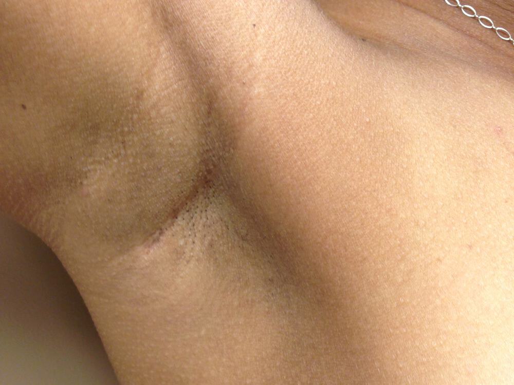 Breast Augmentation Before & After Image