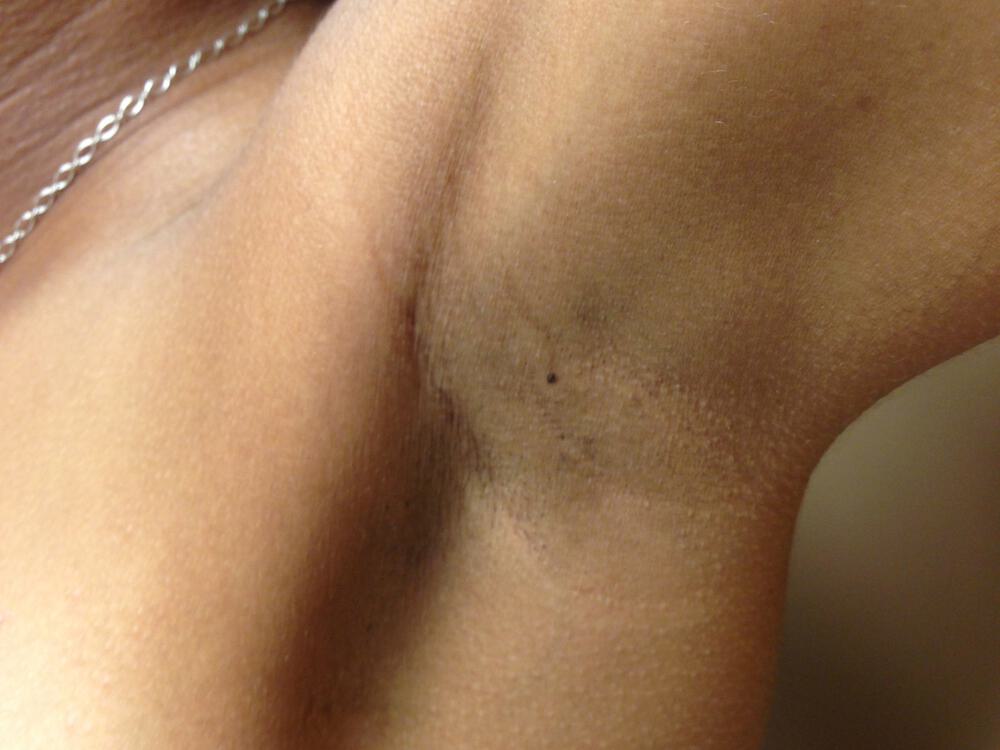 Breast Augmentation Before & After Image