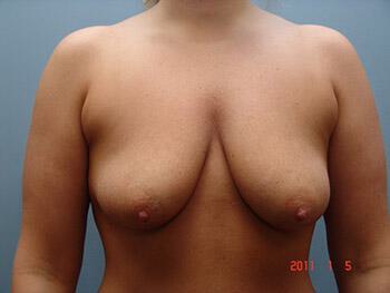 Breast augmentation Before & After Image