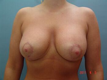 Breast augmentation Before & After Image