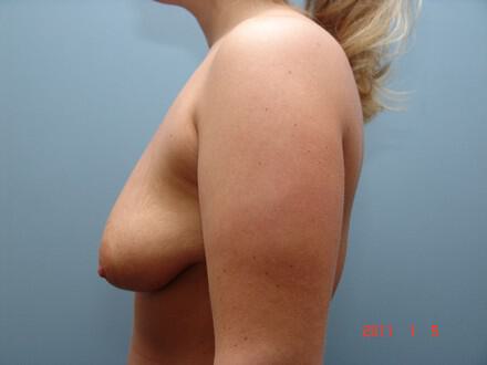 Breast Augmentation Before & After Image