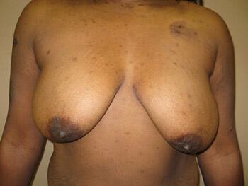 Breast augmentation Before & After Image