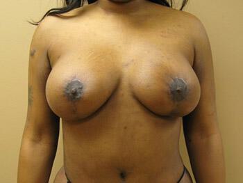 Breast augmentation Before & After Image