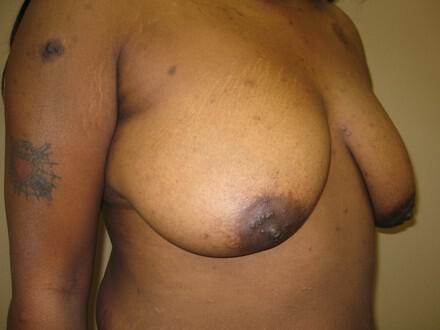 Breast augmentation Before & After Image