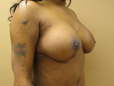 Breast augmentation Before & After Image