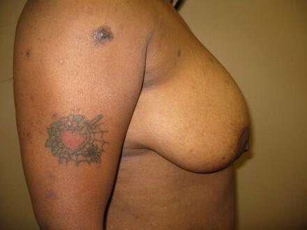 Breast Augmentation Before & After Image