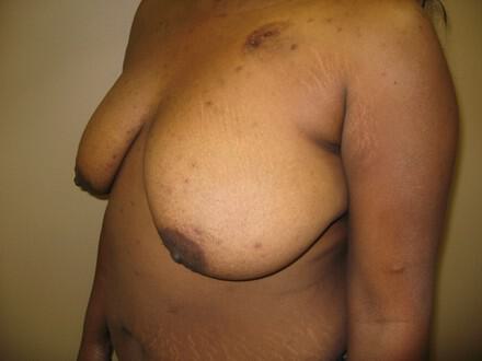 Breast Augmentation Before & After Image