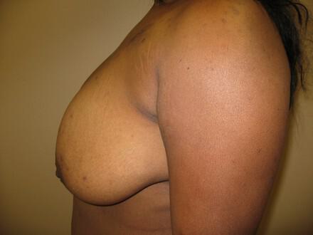 Breast Augmentation Before & After Image