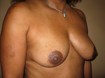 Breast augmentation Before & After Image