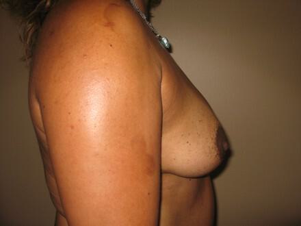 Breast Augmentation Before & After Image