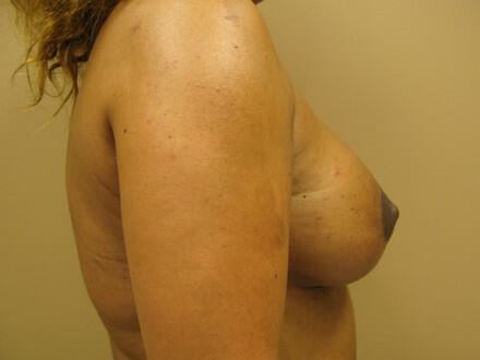 Breast Augmentation Before & After Image