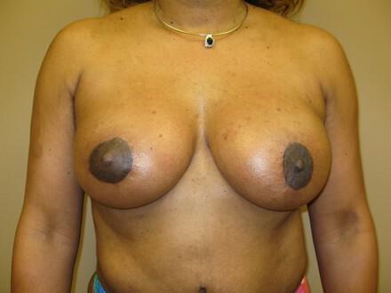 Breast Augmentation Before & After Image