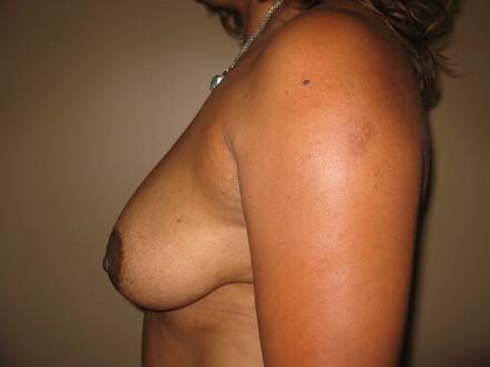 Breast Augmentation Before & After Image