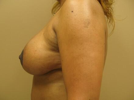 Breast Augmentation Before & After Image