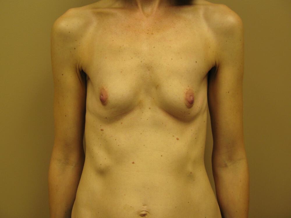 Breast augmentation Before & After Image