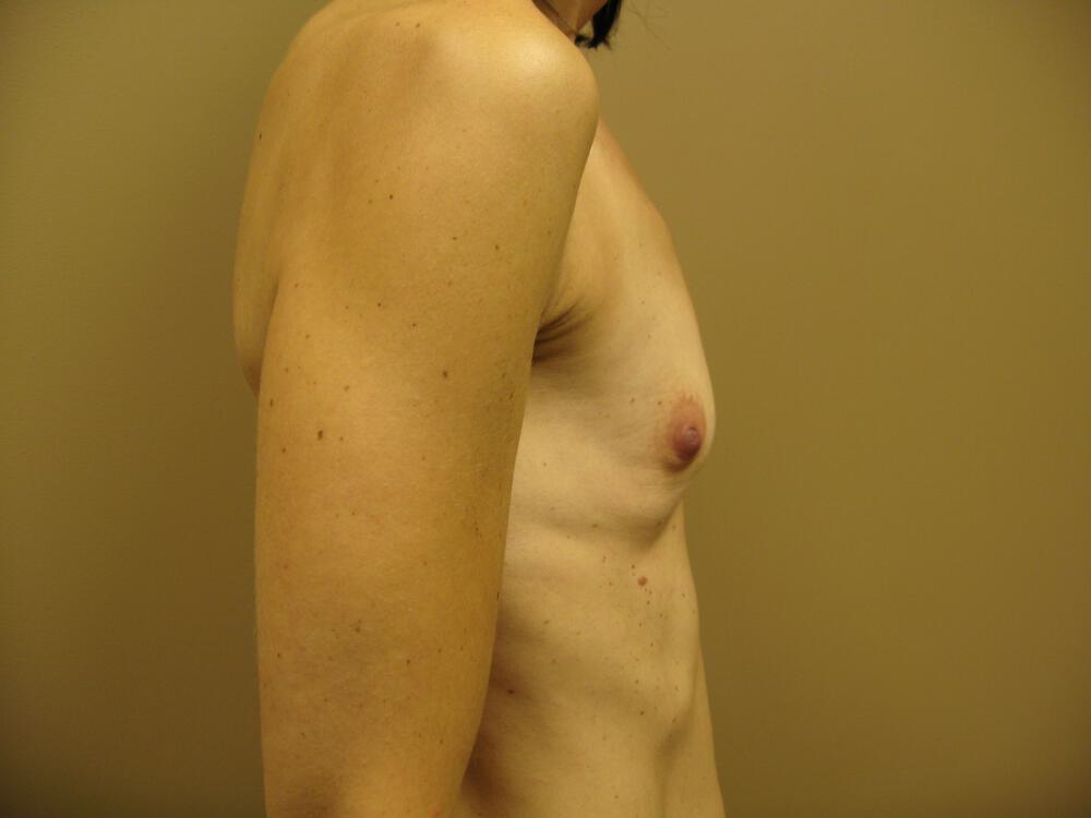 Breast augmentation Before & After Image