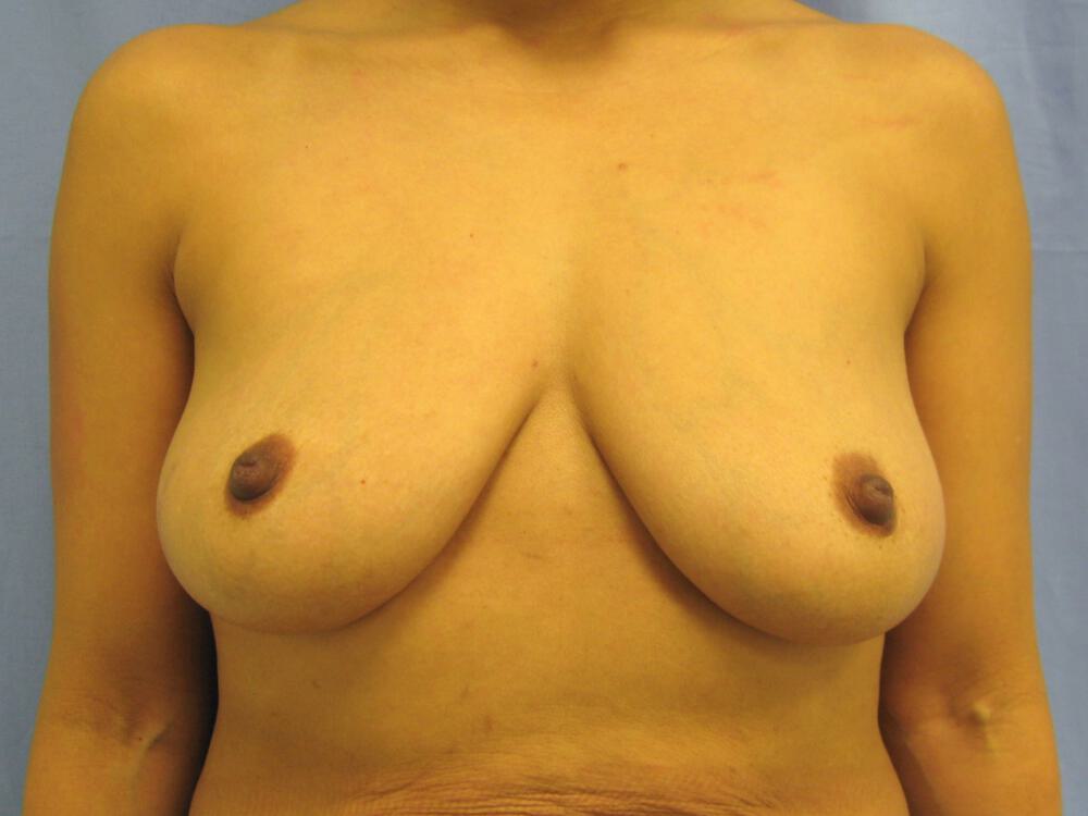 Breast augmentation Before & After Image