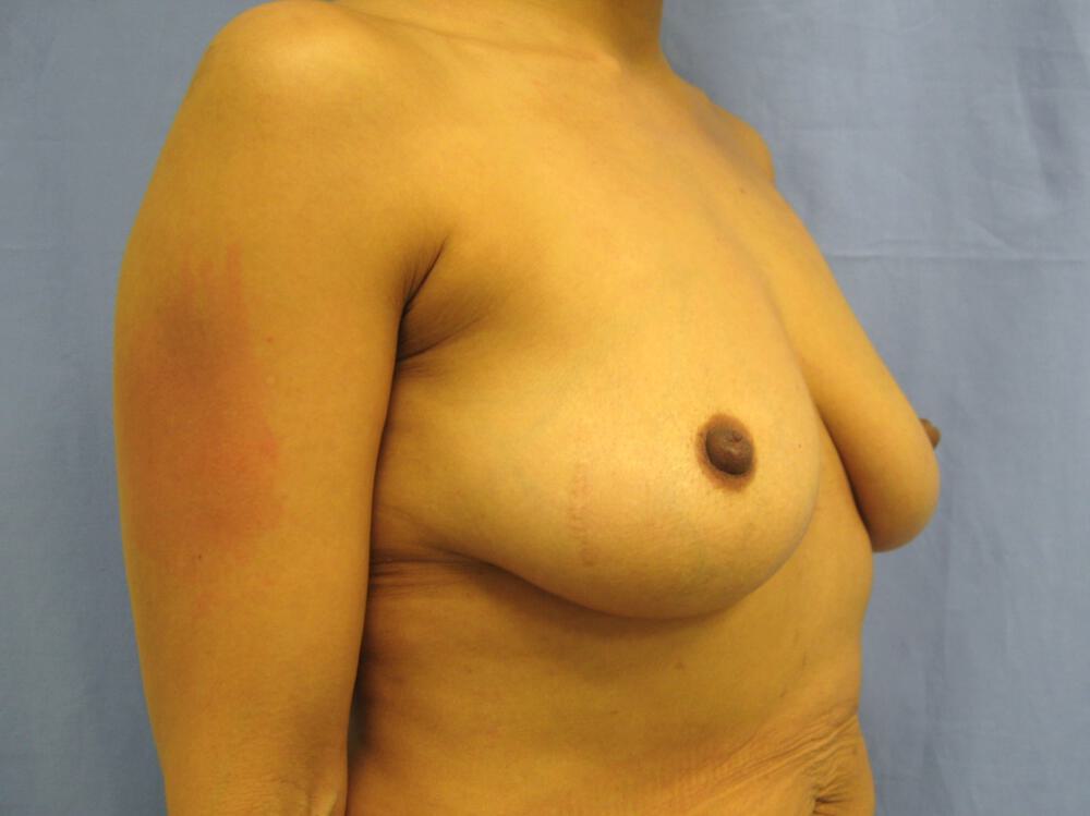 Breast augmentation Before & After Image