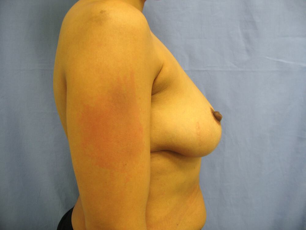 Breast Augmentation Before & After Image