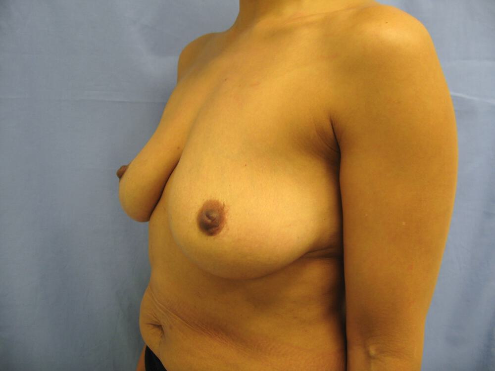 Breast Augmentation Before & After Image
