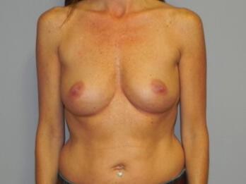 Breast augmentation Before & After Image